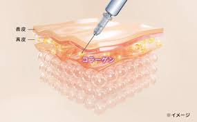 コラーゲン注射（Collagen Injection）について